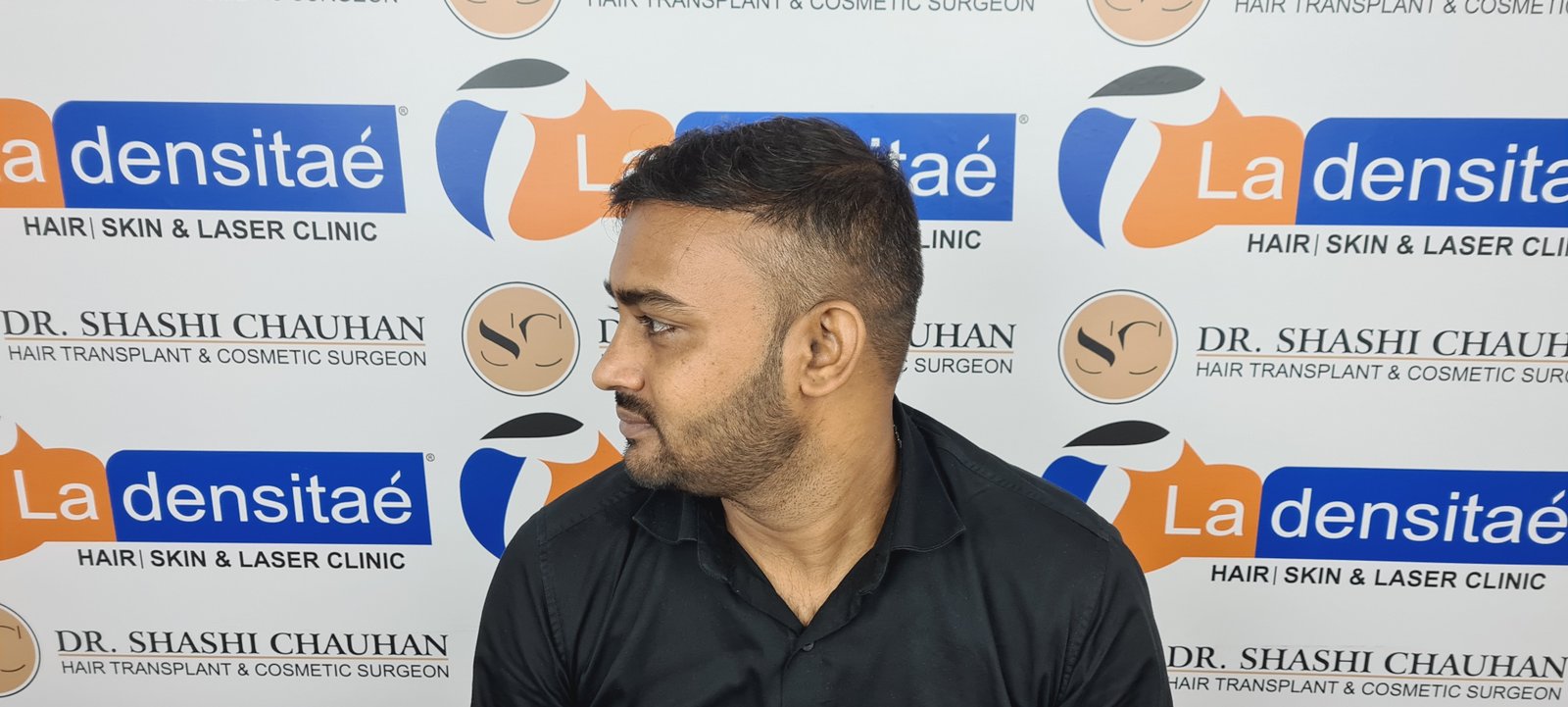 Abhay Pratap Yadav After Hair Transplant